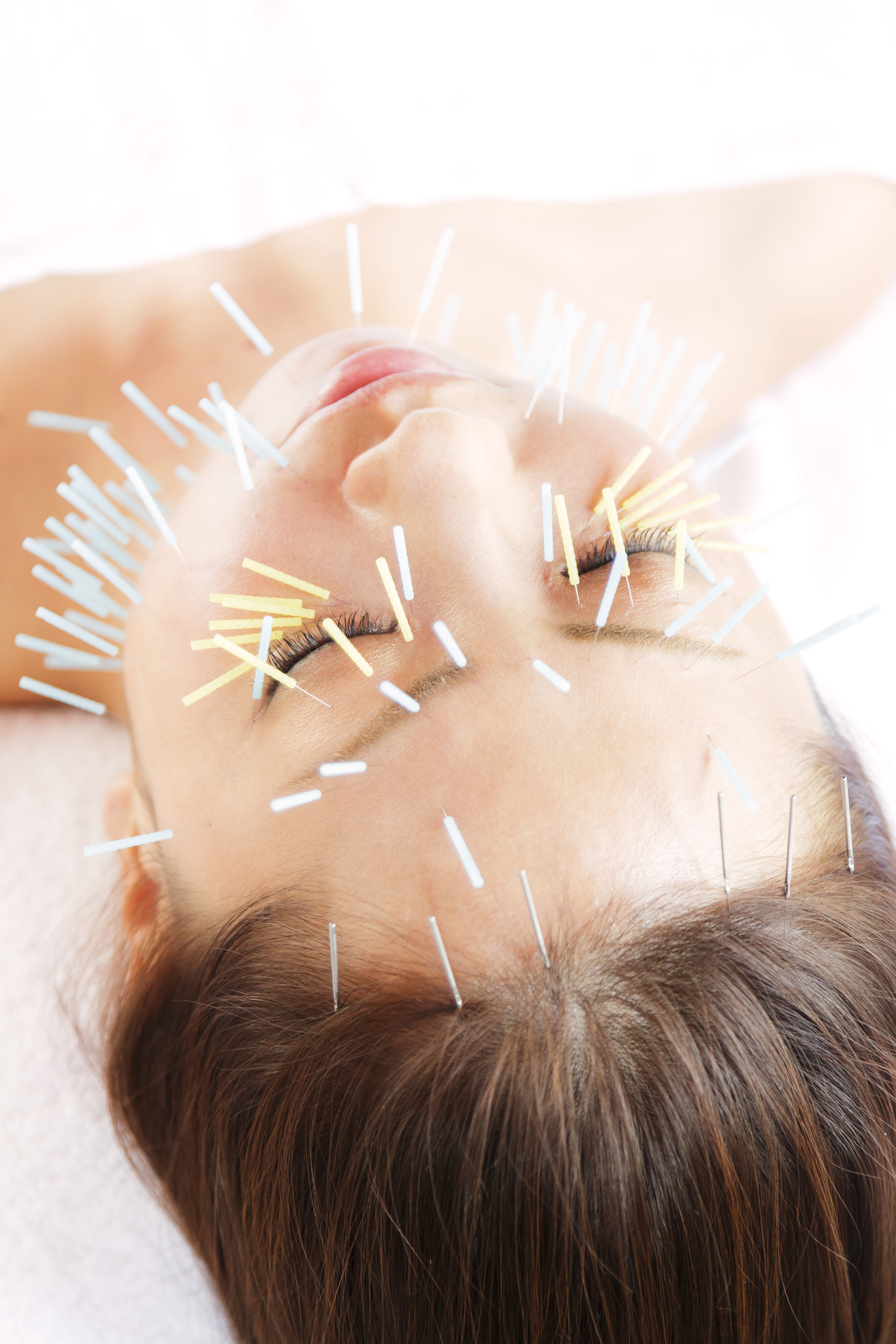 美容鍼灸の施術